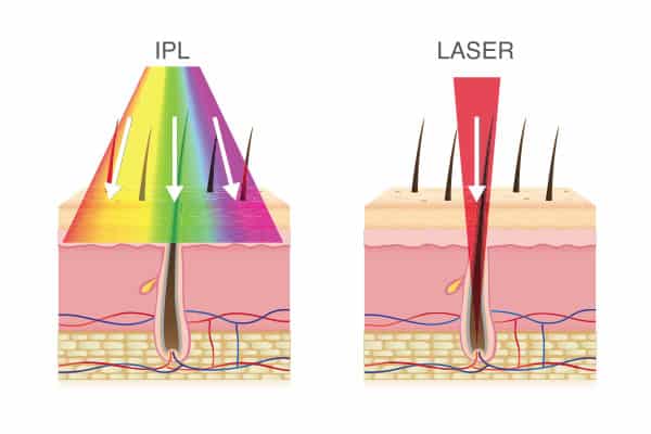 Epilation : lumière pulsée ou laser ?