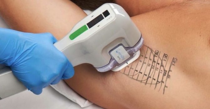 Traitement miraDry - centrelasermontpellier